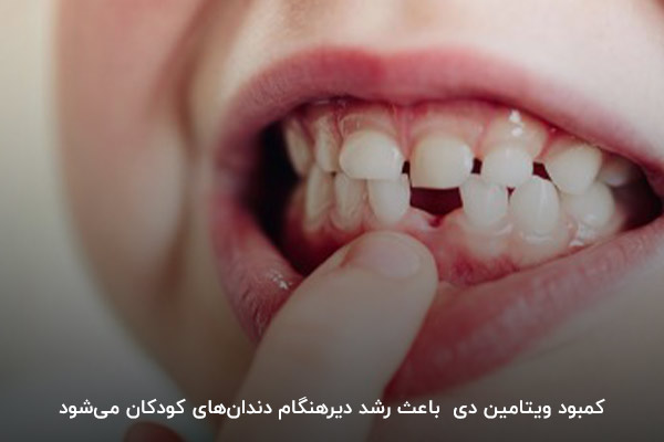 رشد دیرهنگام دندان؛ از عوارض کمبود Vitamin D در بچه‌ها