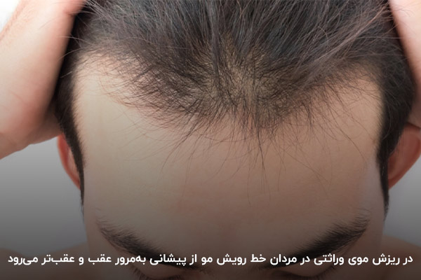 در ریزش مو با الگوی مردانه خط رویش مو از پیشانی عقب و عقب‌تر می‌رود