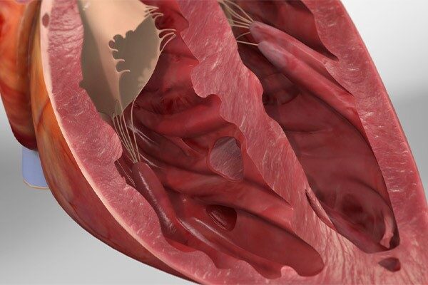 بیماری سوراخ قلب چیست