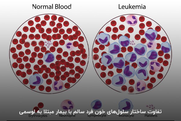 نمونه ساختار خون افراد سالم و افراد مبتلا به لوسمی