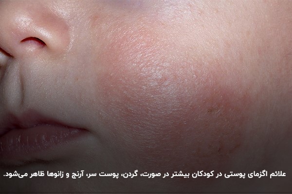 شناخت علائم اگزما پوستی در کودکان؛ مؤثر در درمان اگزما صورت