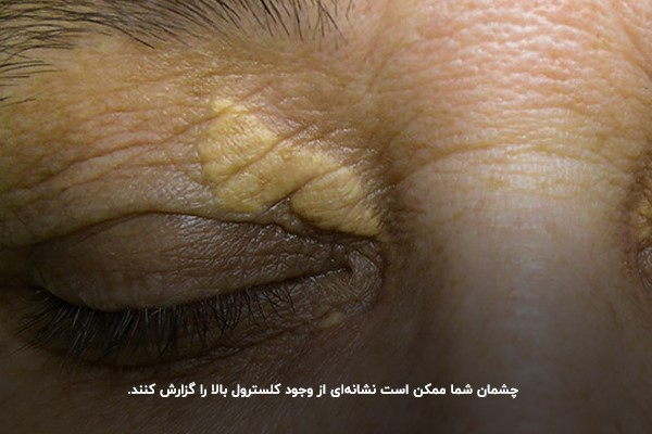 کلسترول بالا و چشم؛ بروز بیماری‌های چشمی در قرنیه و دور پلک