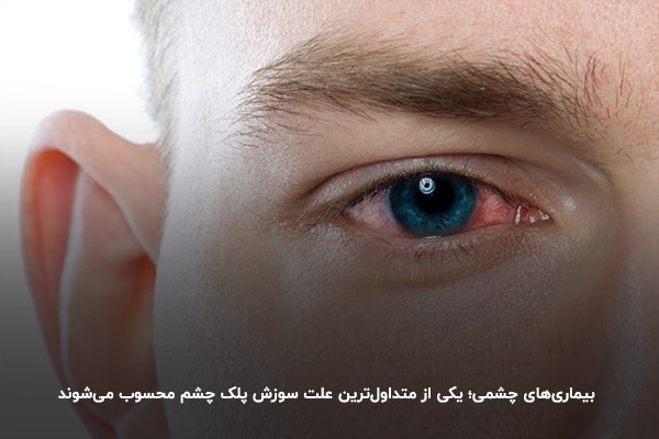 بیماری‌های چشمی؛ یکی از متداول‌ترین علت سوزش پلک چشم