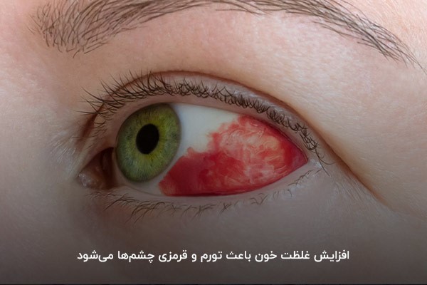  مشاهده قرمزی چشم در افراد مبتلا به غلظت خون 