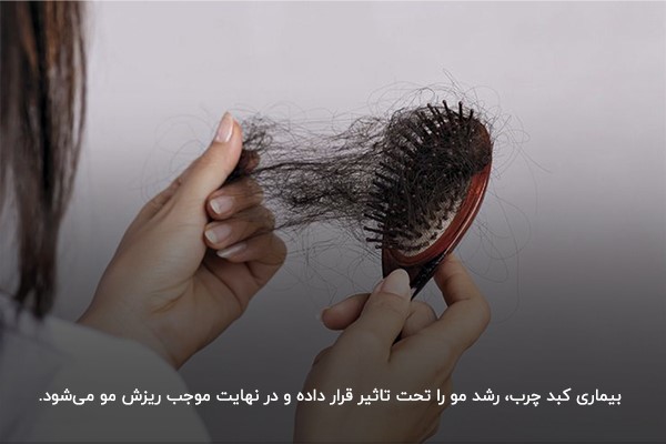ریزش مو؛ یکی از شایع‌ترین علائم کبد چرب در زنان
