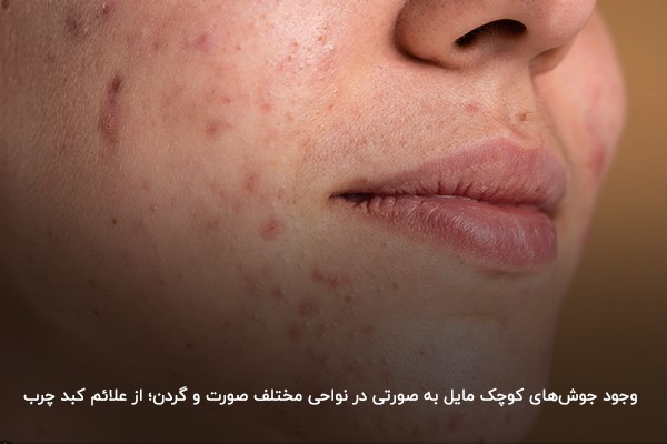 علائم کبد چرب در صورت و چهره؛ نشانه‌های بارز در مردان و زنان
