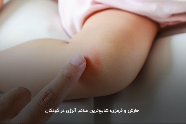 خارش و قرمزی؛ شایع‌ترین علائم آلرژی در کودکان