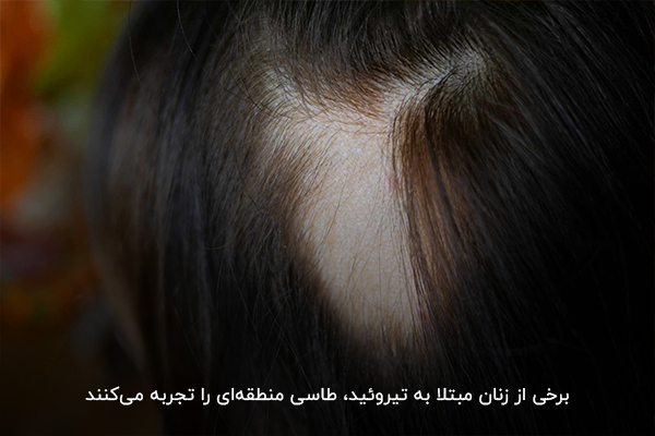 اختلال در فعالیت تیروئید و تاثیر آن بر ریزش موی زنان
