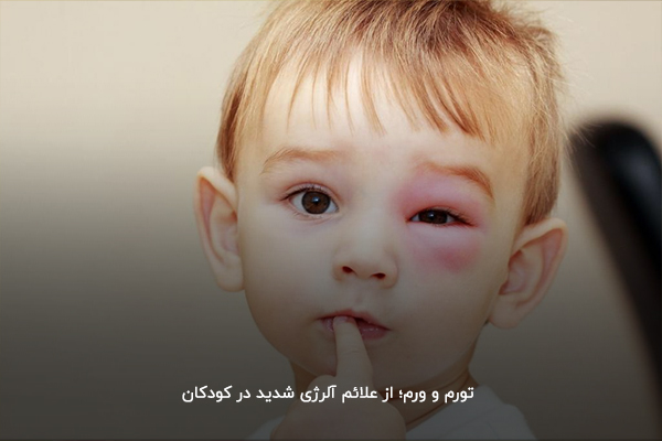 تورم و ورم؛ از علائم آلرژی‌ شدید در کودکان