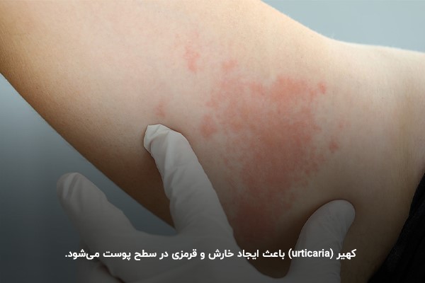 کهیر؛ یکی از انواع حساسیت های پوستی شایع در کودکان و بزرگ‌سالان 
