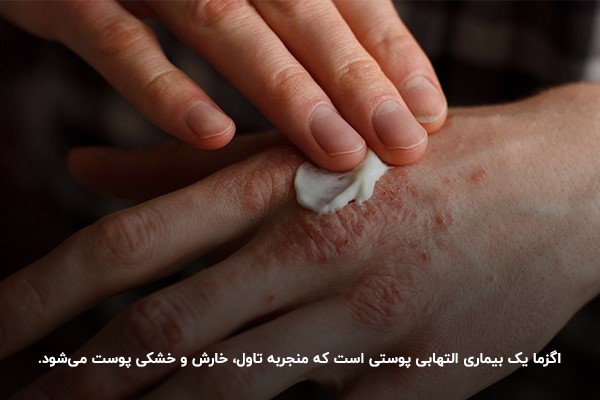 اگزما پوستی؛ نوعی از حساسیت التهابی پوست به همراه خارش و خشکی