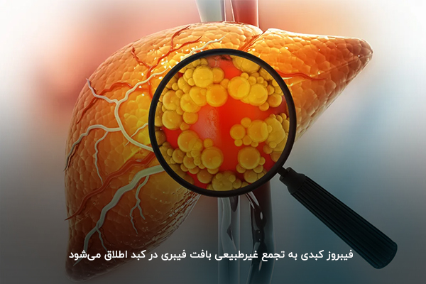 بیماری فیبروز کبدی چیست