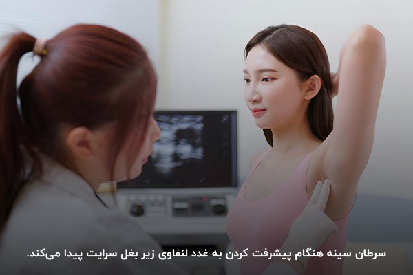 درگیر شدن غدد لنفاوی زیر بغل به سرطان پستان؛ یکی از علائم عود سرطان سینه در زنان
