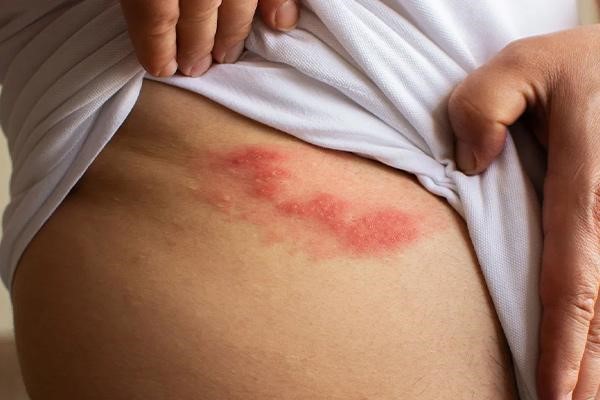 پاسخ به زونا چیست در وبلاگ آدوراطب