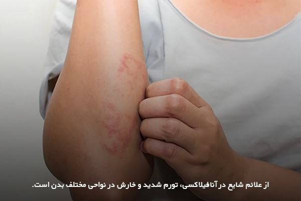 کهیر در زمان آنافلاکسی