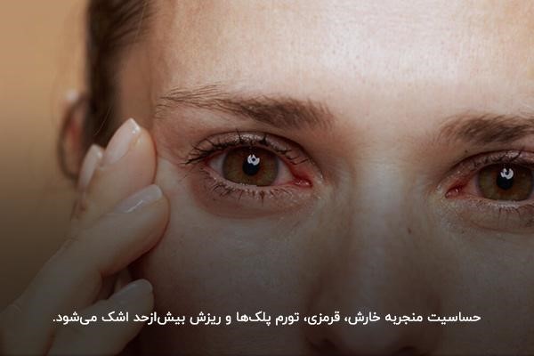 علت خارش و آبریزش چشم