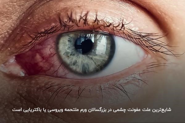 عفونت و آبریزش چشم 