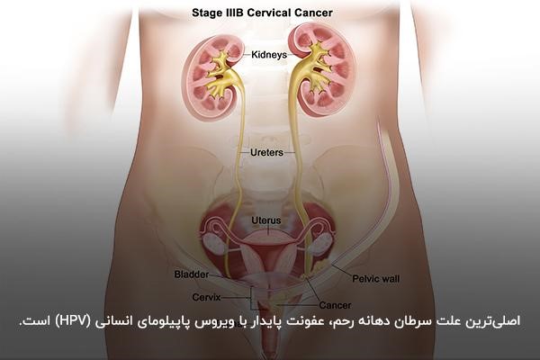 علت سرطان دهانه رحم