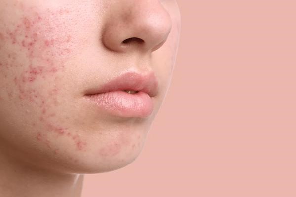 آکنه صورت
