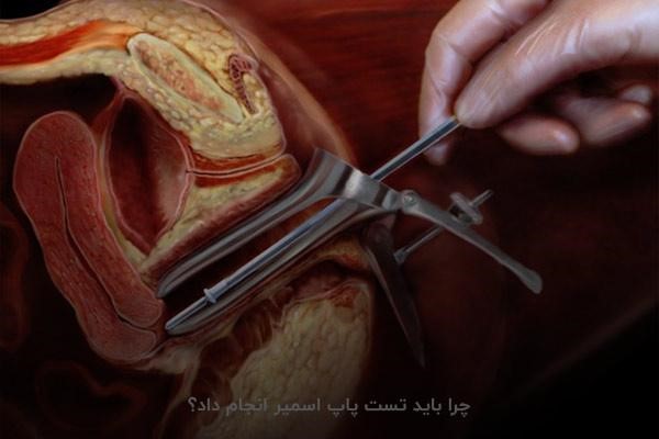 چرا باید تست پاپ اسمیر انجام داد؟