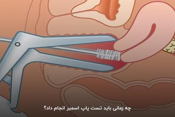 چه زمانی باید تست پاپ اسمیر انجام داد؟