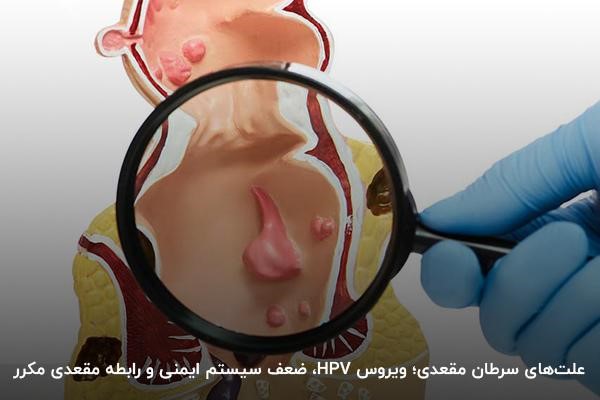 ویروس hpv اصلی‌ترین علت سرطان مقعدی