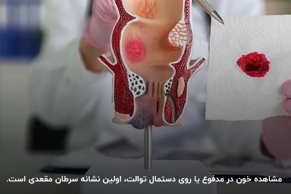 مشاهده خون در مدفوع از اولین نشانه‌های سرطان مقعدی 
