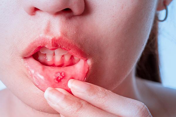 بررسی تفاوت آفت دهان با زگیل دهانی در مجله آدوراطب